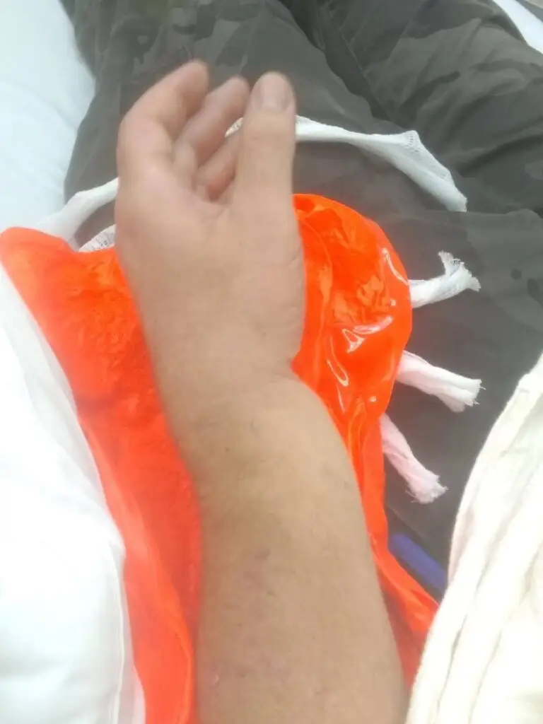 A person with a broken wrist as the result of the fall resting on a hospital bed, with an orange blanket.