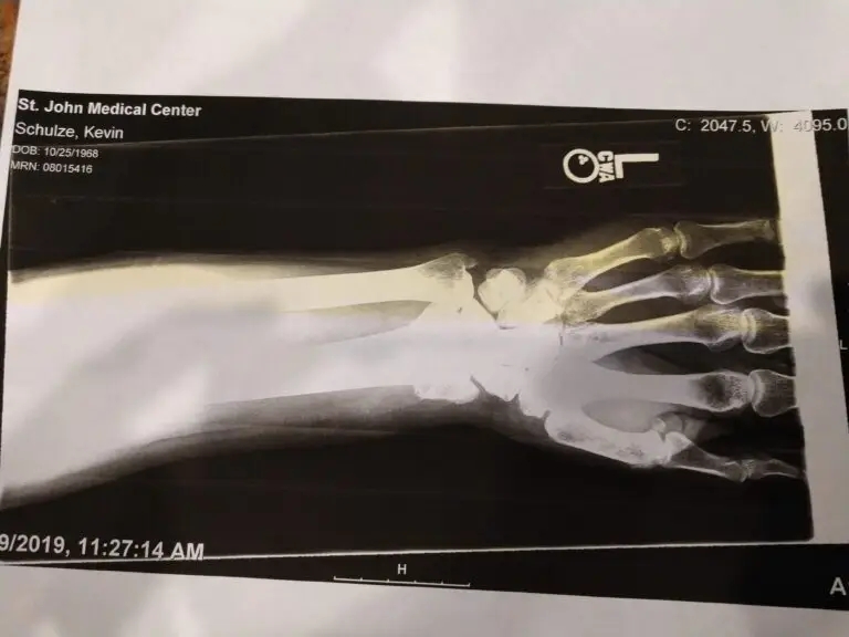 An X-ray of a human foot displaying bone structures. The image includes medical details about the patient from St. John Medical Center with a timestamp from 9/9/2019 at 11:27:14 AM.